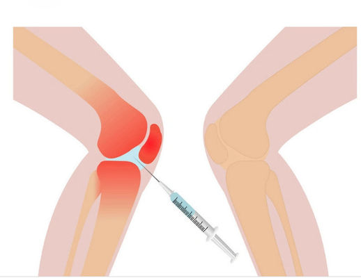 Solution de mésothérapie pour douleur au genou 3ml Acide hyaluronique non réticulé