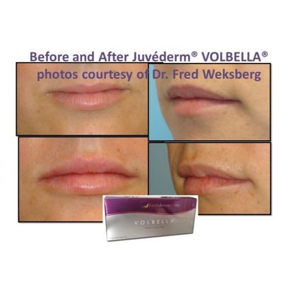 Acide hyaluronique Juvederm Gel de remplissage du visage Peau lisse et sans défaut