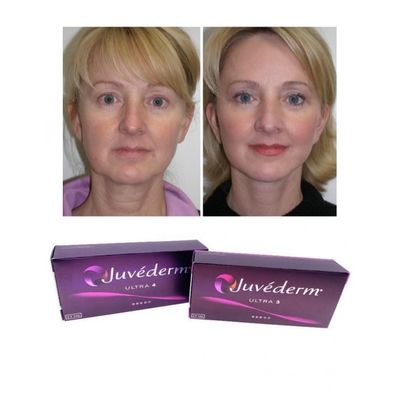 Durée de 6 à 9 mois Gel de remplissage cutané Juvederm Pour achat en ligne et en magasin