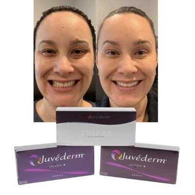 Juvederm Remplisseurs de lèvres cutanés d'acide hyaluronique
