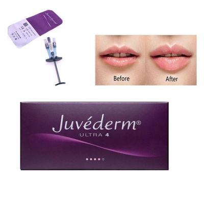 Allergan Juvederm Injection de remplissage cutané Ultra4 avec Lido