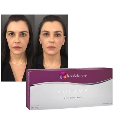 Formule d'amélioration de rajeunissement de joues de lèvres de Juvederm de gel de remplissage cutané d'acide hyaluronique
