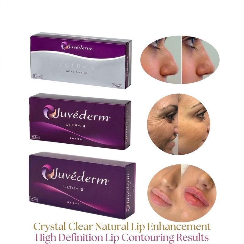 Volume de la seringue 2 1 ml par boîte Juvederm Volume Filler Sécurité Contouring du visage Filler cutané injectable pour augmentation du volume